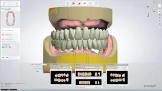 Full Dentures Workflow