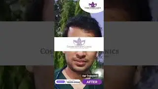 Best hair transplant results in grade 5 male pattern baldness