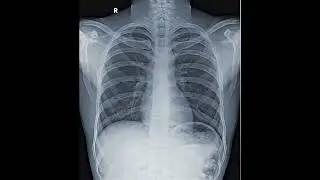Normal X-Ray 🆚 Abnormal Consolidation X-Ray #aiims #biology
