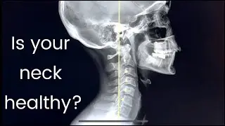 Xray Analysis - Neck Curve