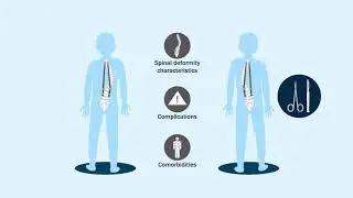 Risk Factors for  Reoperation Following Final Fusion After Treatment of  Early Onset Scoliosis...