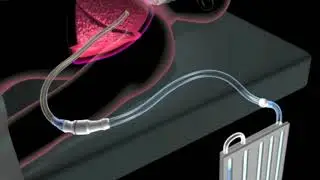 PleuraFlow - How It Works (Close Up)