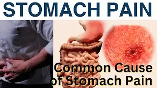 Common Causes and Homeopathy Treatment of Stomach Pain