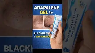 adapalene gel 0.1% for blackhead/ whiteheads
