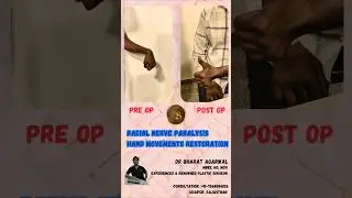 Radial Nerve Palsy, Tendon Transfer, Dr Bharat Agarwal, Udaipur Plastic Surgeon