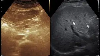 Ultrasound cases 98 of 2000 || Fatty Liver and adenexal mass andIntrahepatic  Billiary calculi