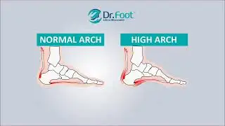 High Arch Foot (pes cavus) - Dr.Foot