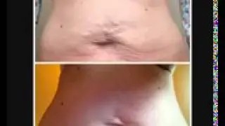 Does Nerium FIRM Really Work
