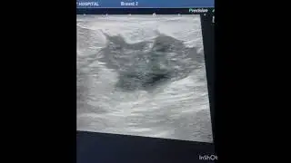 Breast irregular hypoechoic solid mass (F 40y )