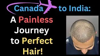 Canada to India:A Painless Journey to Perfect Hair!, For Best Hair Transplant  Technology SmartGraft
