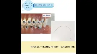 Braces Archwire | Nickel Titanium (NiTi) | Align Braces Clinic