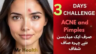 Acne and Pimples Best Homeopathic Treatment | Clear Skin Naturally || Hindi Urdu