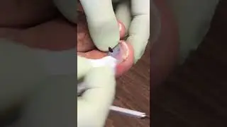 Subungual Hematoma