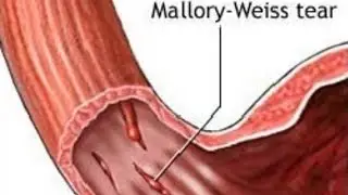 Digestive system part-12 Mallory weiss syndrome esophageal disease