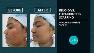 Hypertrophic Scar vs Keloid - Causes and Treatment Reviews and Results