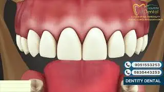 Trauma Root Fracture Explained | Causes, Symptoms & Treatment by Dentity Dental