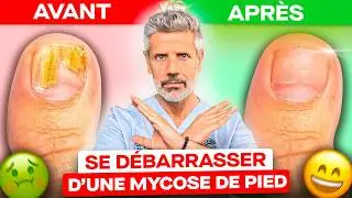 Mycose au Pied : Comment l'Éviter & la Soigner ?
