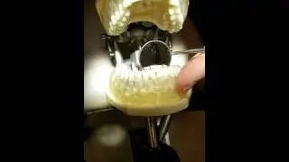 Curettage Anterior Teeth