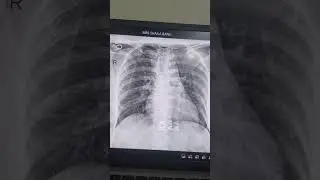 Chest X ray Anatomy For Freshers...... #viral #vlog #medicalstudent
