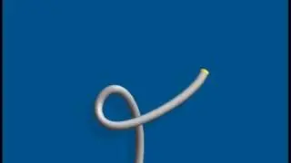 alpha loop in colonoscopy