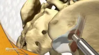 Dr. Kube - SI Joint Fusion Procedure