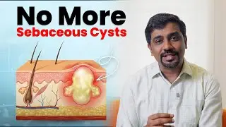 The Only Routine That Actually Works for Sebaceous Cysts Prevention