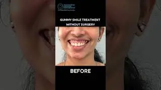 No more hiding that smile! Correct your gummy smile without surgery and embrace your best self.