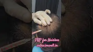 PRP for Hairloss #prphairtreatment #imwell #drpriyasharma #drpriya