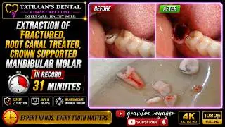 CASE#25 #dentistvlog #teethimplants #cosmeticdentistry #dentaltransformation #veneers #dentistvisit