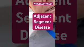 Adjacent segment disease after a spine fusion #AdjacentSegmentDisease #FineFusion #SpineSurgery