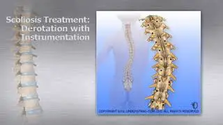 Thoracic Scoliosis Treatment Derotation with Instrumentation