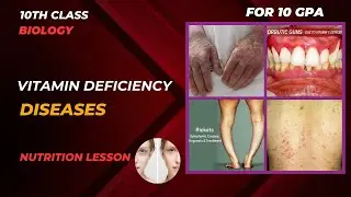 Vitamin Deficiency Diseases, Pellagra, Beri Beri, Anemia, Glossitis, arthritis and explanation