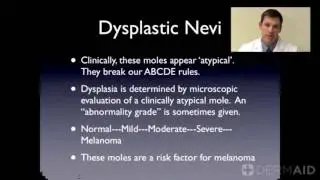 Atypical Nevi