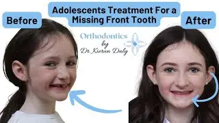 ADOLECENT - TREATMENT OF MISSING TEETH - SUBSTITUTION OF MISSING CENTRAL INCISORS