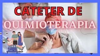 CATÉTER DE QUIMIOTERAPIA