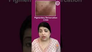 Types of pigmentation on face #shorts #youtubeshorts #pigmentation