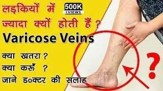 Varicose Veins Treatment In Hindi, Causes, Complications, Treatment, LASER Surgery, blood Clot Leg
