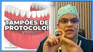 Tamp&atilde;o de implante: O que usar para vedar os acessos?| Master Pride Odontologia | Dra Bianca Rosa