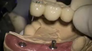 Dental implant/  Screw and cement-retained provisional restoration setting 3