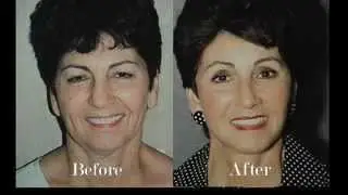 Facial Rejuvenation Plastic Surgery Before & After Pictures | Facelift Houston TX