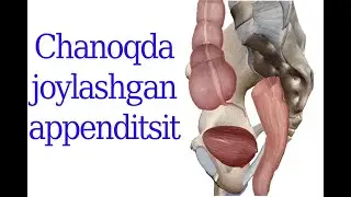 Chanoqda joylashgan appenditsit haqida ma'lumot 4 kurs talabasi Amirqulova Mashhura