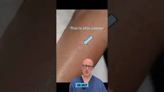 Is This Skin Lesion Dangerous? Why a Biopsy Matters