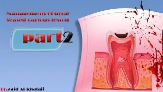 شرح  Direct pulp capping | (محاضرة جامعة الرافدين)
