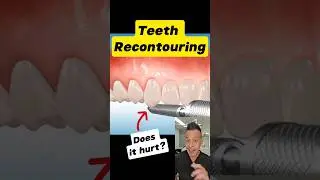 Does Tooth Recontouring Hurt? The Truth Revealed! #dentallan #dentist #shorts