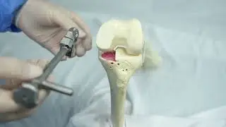 AFK Surgical Technique&mdash;&mdash;AK UKA（Unicompartmental Knee Arthroplasty）