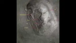 Mars Cydonia face is an Upside down ALIEN GREY HEAD!