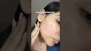 VIT C CAUSING MORE DAMAGE ‼️check description #acne #vitcserum #skincare #acnetips