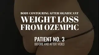 Tummy Tuck After Pregnancy & 112 lb Ozempic Weight Loss | Body Transformation by Dr. Cynthia Mizgala