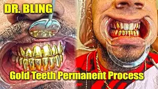 Gold Teeth Permanent Process | DR. Bling