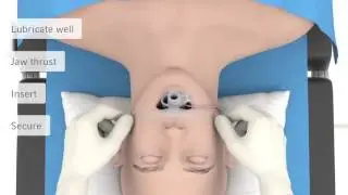 LMA ® Protector ™ Airway Product Quick Reference
